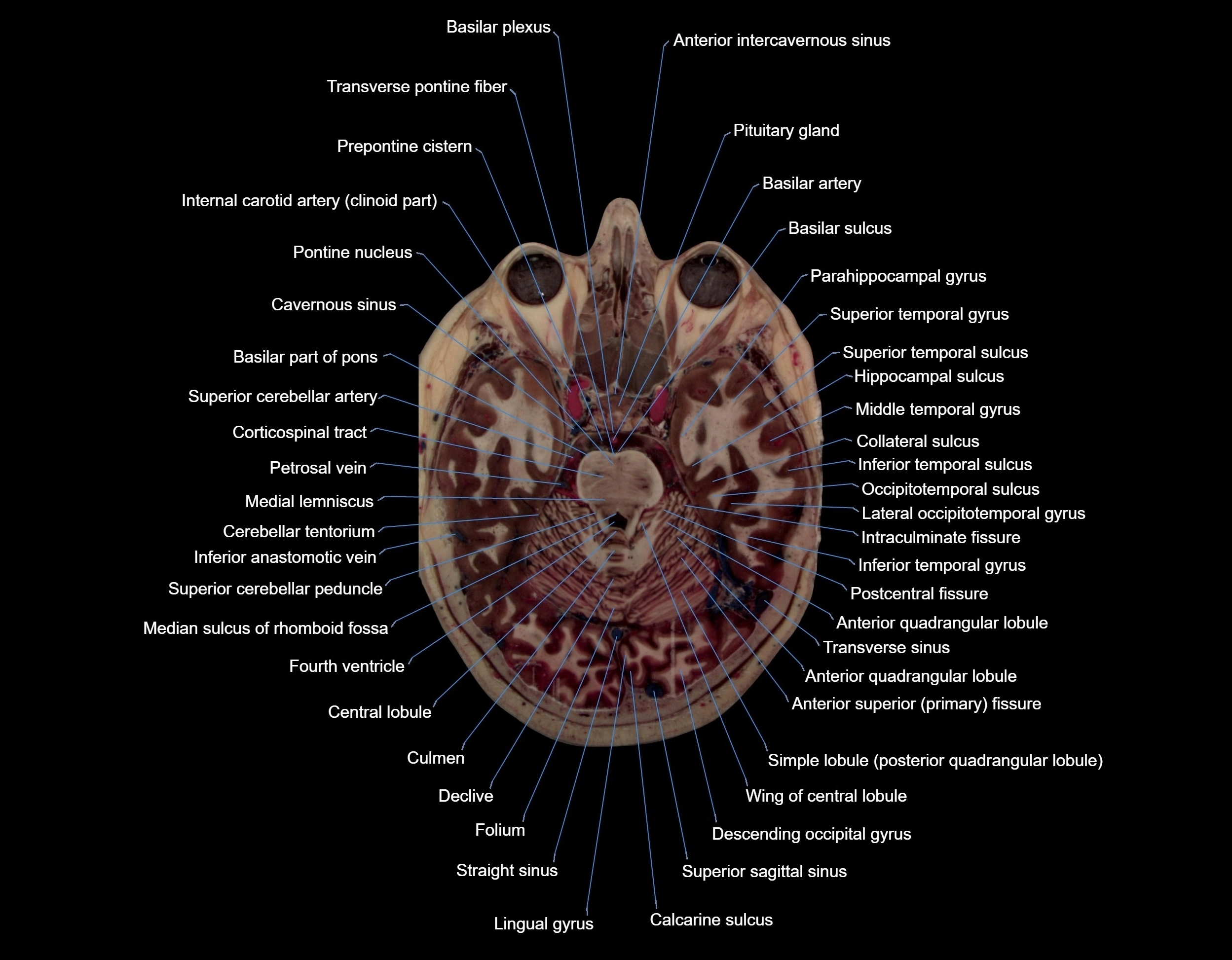 MRI Brain axial cross sectional radiology anatomy 3T image  -img-000028.webp